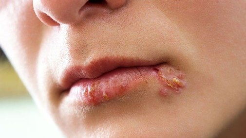 تامێسک (herpes)